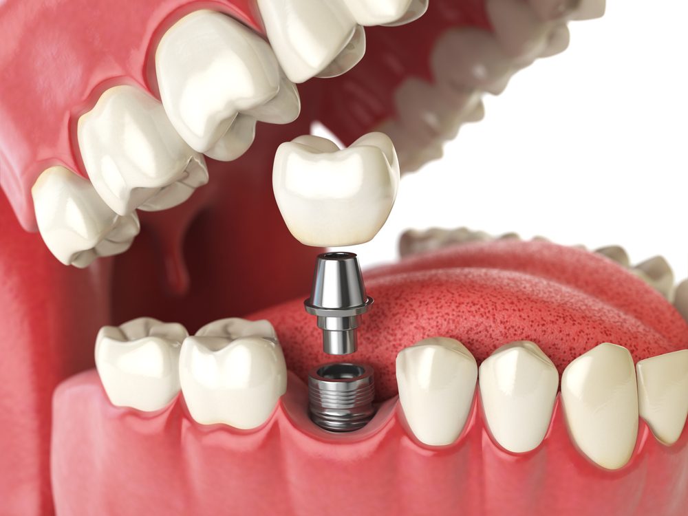 Gain Confidence with Helpful Dental Implants