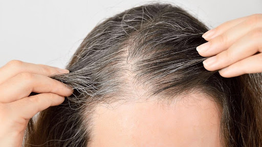 7 Things You Have to Know About Hair Transplants for Women